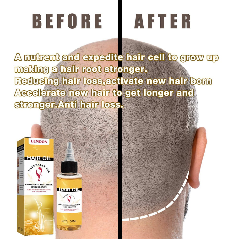 50ml Hair Oil for Anti-hair Loss, Hair Growth and Scalp Health 