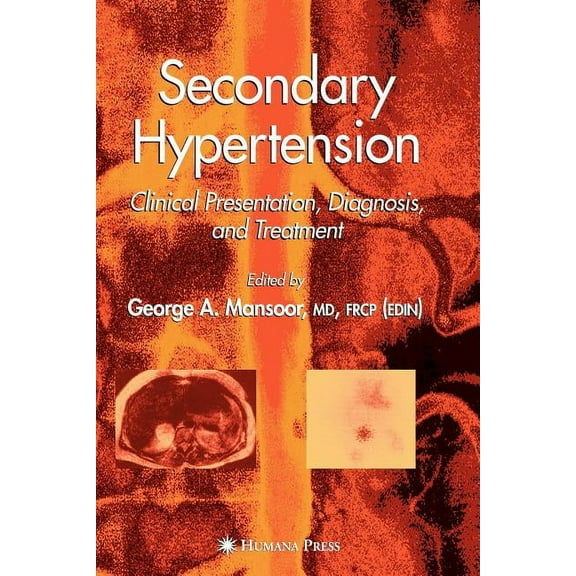 Clinical Hypertension and Vascular Disea Secondary Hypertension: Clinical Presentation, Diagnosis, and Treatment, (Paperback)