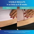 thumbnail image 6 of ScarAway Silicone Scar Sheets Shrink, Flatten and Fade Scars, Clear, 6 Count, 6 of 11