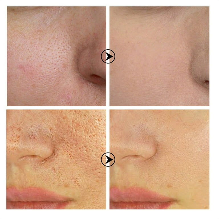 2PCS Acid Pore Refining Cream Salicylic Face Cream Professional Pore Minimizer Refine Pores And Improve Blackheads Moisturizing Repairing 20g best