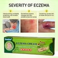 thumbnail image 3 of Crema Eczema, Piel Seca, Tratamiento Eczema, Crema Caléndula, Dermatitis, Manos Secas, Cutículas, Nudillos, Talones, Ungüento Caléndula, 3 of 4