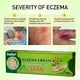 thumbnail image 3 of Crema Eczema, Piel Seca, Tratamiento Eczema, Crema Caléndula, Dermatitis, Manos Secas, Cutículas, Nudillos, Talones, Ungüento Caléndula, 3 of 4