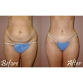 thumbnail image 2 of Tummy Tuck Miracle Slimming System Belt Size 1 2 3 TRUSTED & ORIGINAL As on TV, 2 of 7