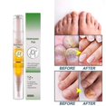 thumbnail image 3 of Nail Fungus Solution Toenail and Fingernail Care Pen Nail Fungal Pen, 3 of 5