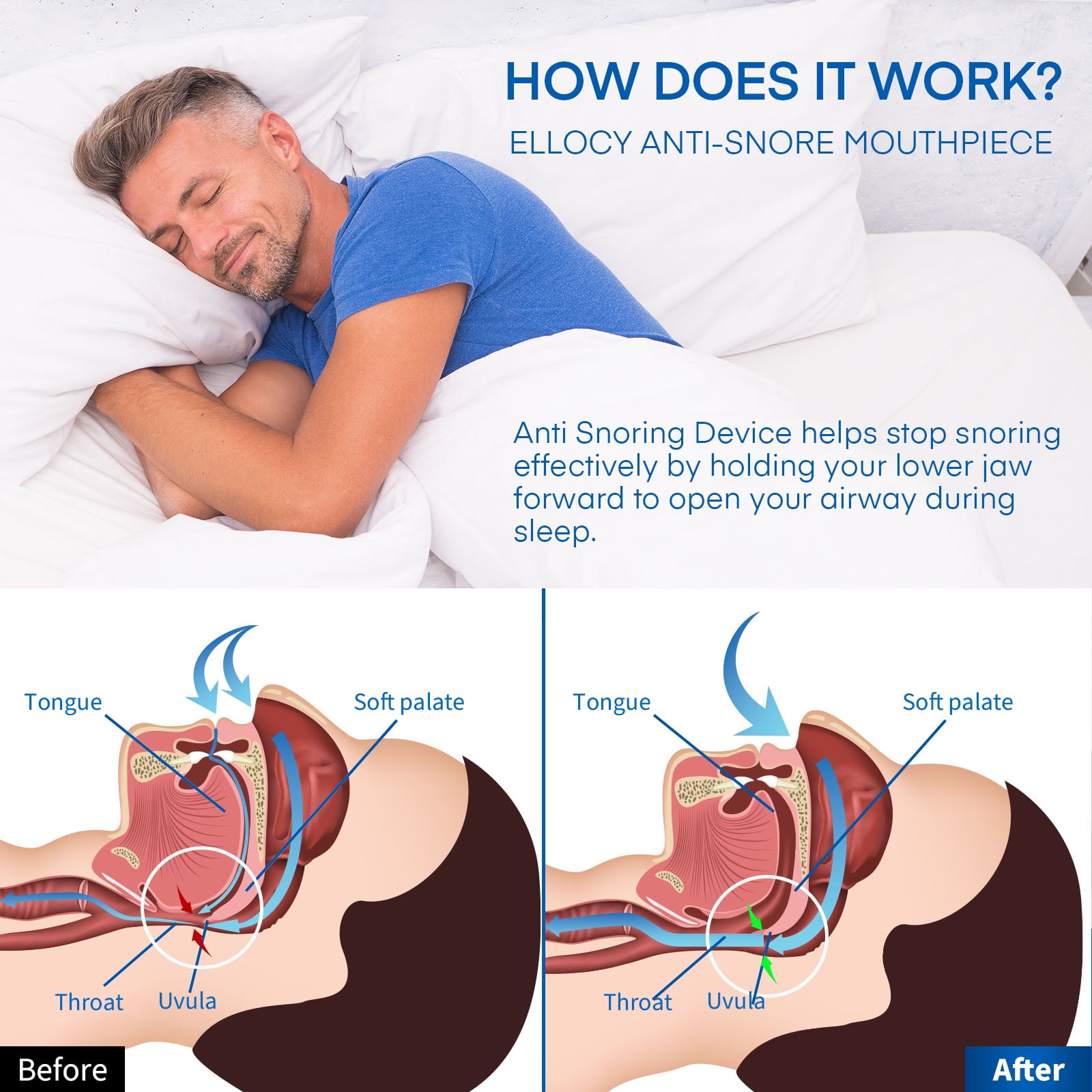 Ellocy Anti Snoring Devices – Mouth Guard for Snoring & Teeth Grinding, Adjustable Fit for Men & Women
