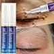 thumbnail image 1 of Wart Remover Pen Skin Tag Mole Remover Eliminate Foot Corn Warts Treatment Cream, 1 of 3
