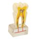 thumbnail image 3 of Modelo de Caries Dental Estudio Modelo de Dientes Estándar Demostración Patológico Educativo Herramientas de Enseñanza de Dientes 6 Veces Caries Modelo de Dientes Suministros ANGGREK  Otros, 3 of 8