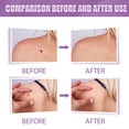 thumbnail image 1 of Removedor de marcas en la piel y removedor de verrugas (4 paquetes) LingWen 9024715812872, 1 of 1