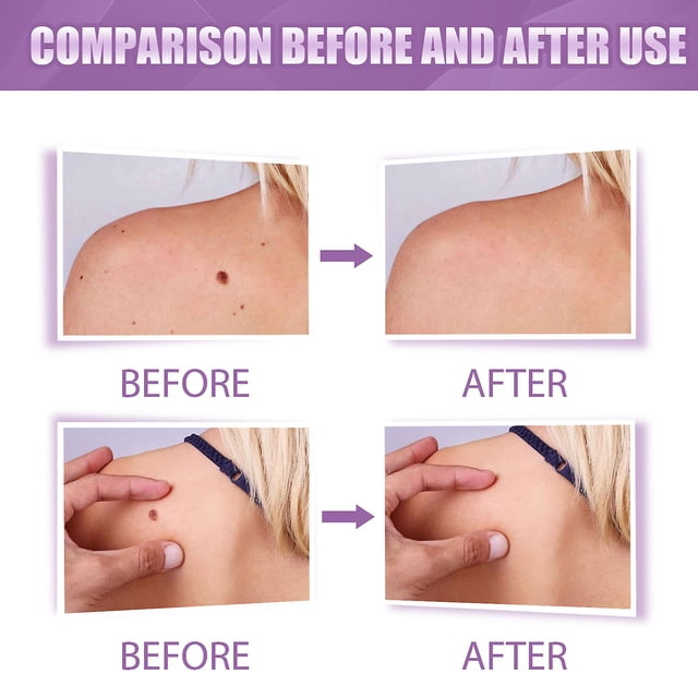 Removedor de marcas en la piel y removedor de verrugas (4 paquetes) LingWen 9024715812872