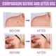 thumbnail image 1 of Removedor de marcas en la piel y removedor de verrugas (4 paquetes) LingWen 9024715812872, 1 of 1