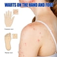 thumbnail image 4 of Pomada para eliminar verrugas, herpes genital, vulva genital, condiloma acuminado, eliminador de marcas en la piel, crema de tratamiento antibacteriano, 4 of 5
