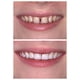 thumbnail image 5 of Reparación de encías con dientes sólidos Brackets caseros para dentaduras postizas Brackets de vampiro Brackets de tigre, 5 of 5