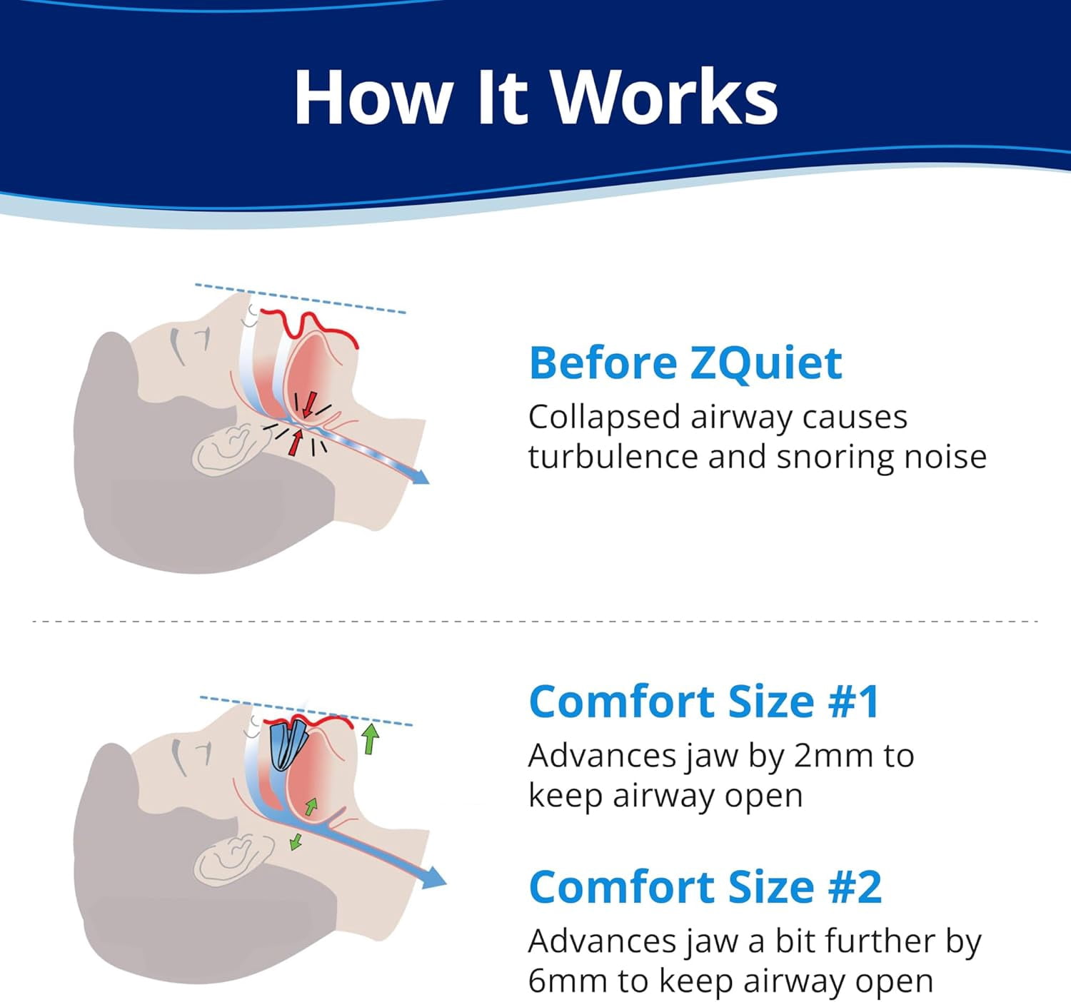 AWT 2Pack Anti-Snoring Mouthpiece, Living Hinge & Open Front Design for Comfort & Easy Breathing, (Transparent).