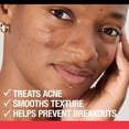 thumbnail image 5 of Limpiador facial Neutrogena Stubborn Texture con ácido salicílico 180 ml, 5 of 5