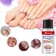 thumbnail image 4 of Gotas potentes para el tratamiento de hongos en las uñas de los pies: solución antifúngica para las uñas de los pies., 4 of 5