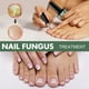 thumbnail image 2 of Líquido Para Hongos En Las Uñas Líquido Para El Cuidado De Hongos En Las Uñas, 15Ml, Reparación De Esencia De Uñas, Reparación De Cutículas De Uñas De Los Pies Dañadas Ndcxsfigh  Cuidado Belleza, 2 of 3