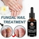 thumbnail image 5 of Anti-Fungal Nail Treatment Serum for Toes & Feet Care Essentials Repair Herb Solution Against Onychomycosis Paronychia Infections, 5 of 5