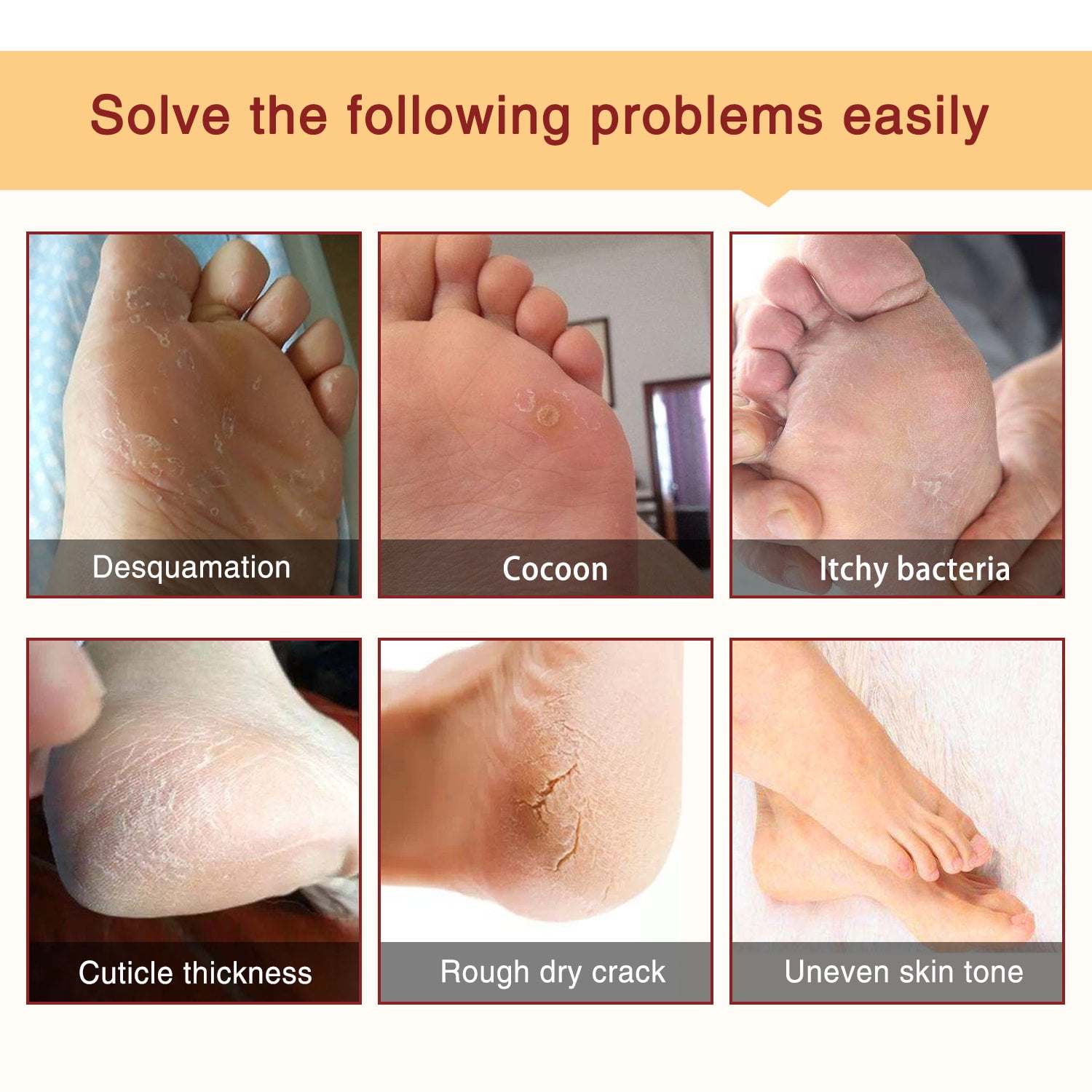 Callus Foot Peel (Hard Skin Removal) - Beauty Salon in Orpington