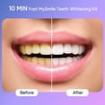 thumbnail image 6 of MySmile Ultimate Teeth Whitening Kit with 28 LED Light, 4X 3ML 35%CP Teeth Whitening Gel, 1X 4ML Teeth Whitening Pen, 10 Min, Remove 10 Years of Stains, 6 of 16