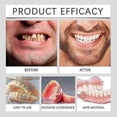 thumbnail image 5 of Premium Denture Set, Advanced Silicone Reline Denture Set Cosmetic Teeth Veneers for Perfect Smile, 5 of 5