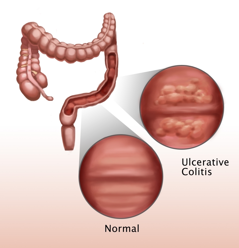 Ulcerative Colitis Poster Print by Spencer SuttonScience Source (18 x