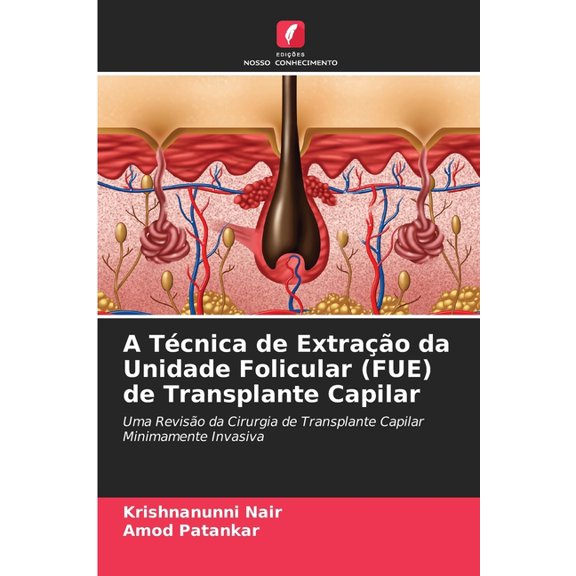A TÃ©cnica de ExtraÃ§Ã£o da Unidade Folicular (FUE) de Transplante Capilar, (Paperback)
