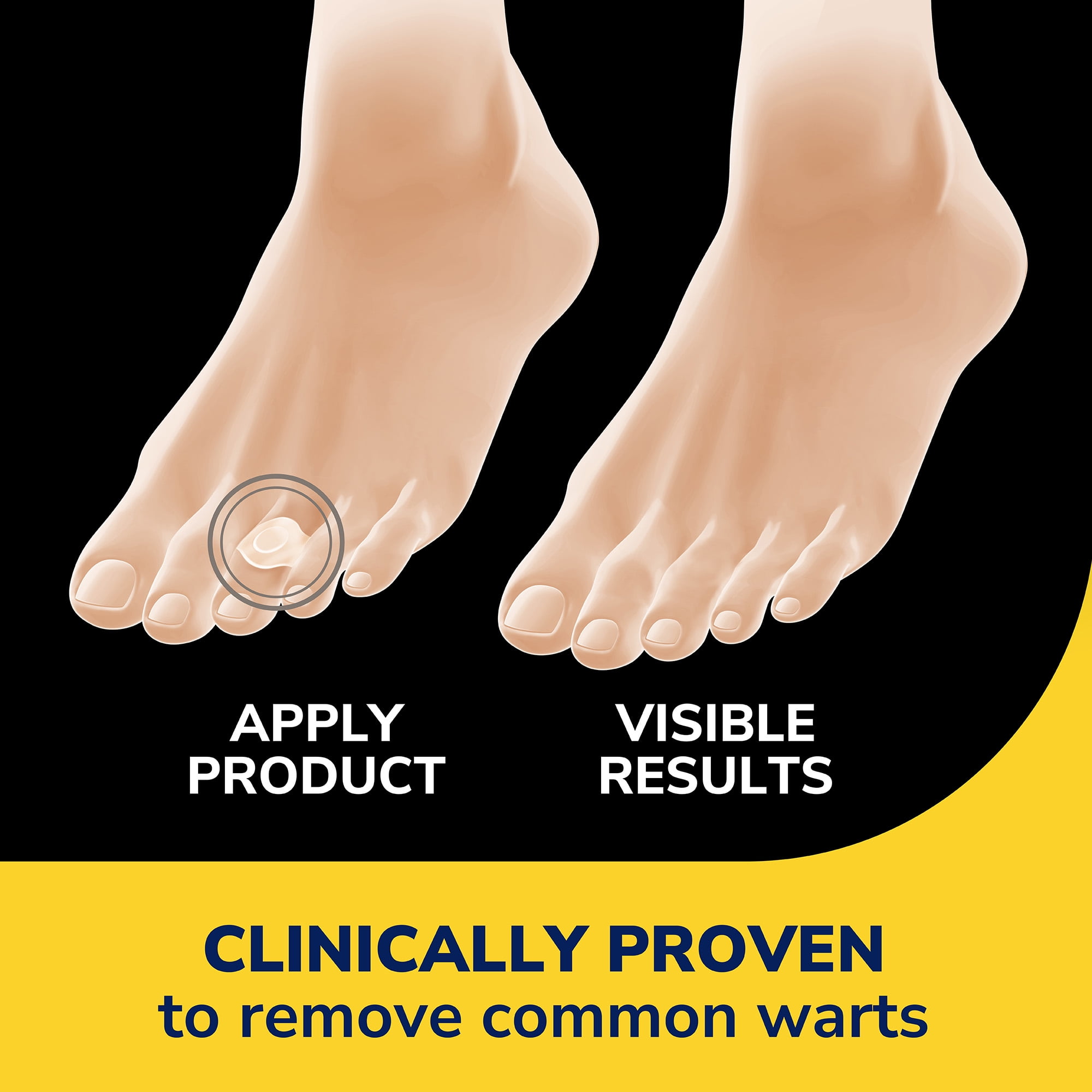 Dr. Scholl's Clear Away® Wart Remover Hydrogel Bandages, 12 Discs, 9 Pads