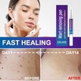 thumbnail image 2 of 1pcs 12 Hours Wart Remover Pen Skin Tag Mole Remover Remove Corn Warts on Feet Unisex, 2 of 5