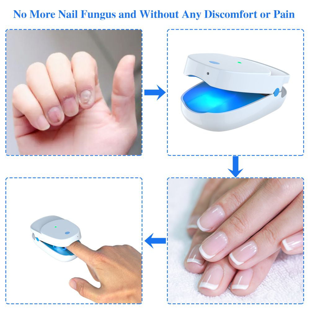 Nail & Foot Care Roscommon - Fungal Nail Treatment ☆ damaged nail particles  removed ☆ nails sealed ☆ home medicaments prescribed #dontignore #signs  #call #gethelp #foot #consultation #free | Facebook