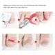 thumbnail image 5 of Ingrown nail ingrown nail correction sticker nail correction patch toenail correction sticker foot care tool Ingrown Toenail Correction Sticker Nail Ingrowing Correction Patch Foot ANGGREK Otros, 5 of 8
