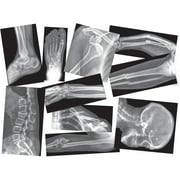 Roylco, RYLR5914, Broken Bones x-rays Set, 15 / Box