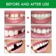 thumbnail image 4 of Kit de reparación de dientes temporales con 3 herramientas dentales Herramienta de cuidado de dientes para hombres y mujeres Sywqhk Cuidado Belleza, 4 of 5