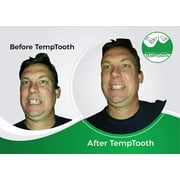 Temptooth #1 Seller Temporary Tooth Replacement Kit, Missing Tooth Kit, DIY Tooth Replacement, Affordable Dental Repair, Emergency Missing Tooth Fix