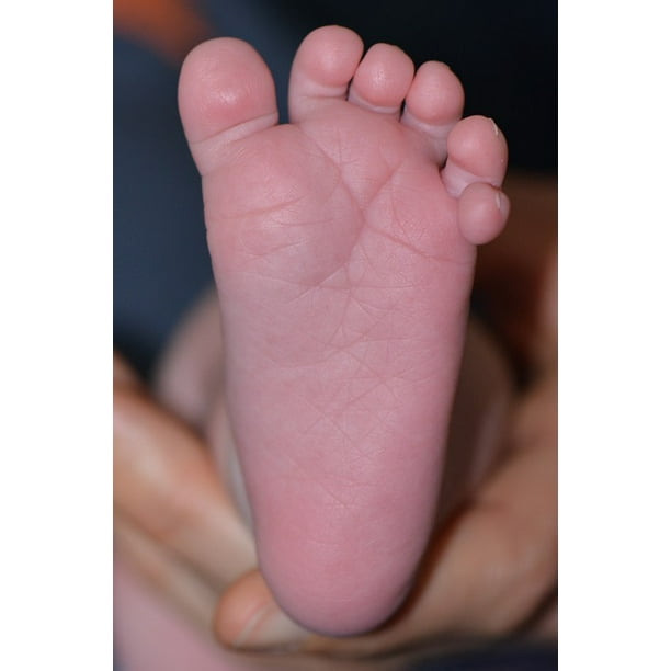 Baby Foot Toes Foot Six Toes12 Inch By 18 Inch Laminated Poster With