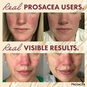 Prosacea Gel for Rosacea Redness, Pimples, and Irritation, Sulphur 1x, 0.75 oz Tube