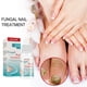 thumbnail image 1 of Esencia De Eliminación De Hongos En Las Uñas Solución De Reparación De Uñas Gris Paronychia Nail Fungus Care Liquid Care Essence Liquid Ndcxsfigh  Cuidado Belleza, 1 of 3