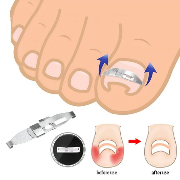 XIRQI Ingrown Toenail Corrector Toenail Correction Tool Foot Nail Care Tool Orthotic Nail Corrector Pedicure Tool