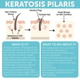 thumbnail image 5 of Exfoliante corporal KP Bump Eraser, queratosis pilaris, tratamiento para mujeres, 5 of 5