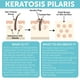 thumbnail image 5 of Exfoliante corporal KP Bump Eraser, queratosis pilaris, tratamiento para mujeres, 5 of 5