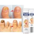 thumbnail image 2 of Crema para tratamiento de hongos en las uñas, onicomicosis, paroniquia, antiinfección, hongos en los dedos de los pies, manos, eliminación, Gel de reparación, cuidado, belleza, salud, 2 of 5
