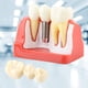 thumbnail image 2 of 1 modelo dental de demostración dental de resina, modelo de kit dental de tres coronas, análisis de implantes desmontable puente de corona dental, para programas de enseñanza dental brillar Electrónica, 2 of 5