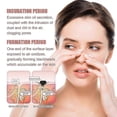 thumbnail image 3 of Jaysuing Of Blackhead Removal Nose Mask Deeply Cleans Blackheads And Pimples |, 3 of 4