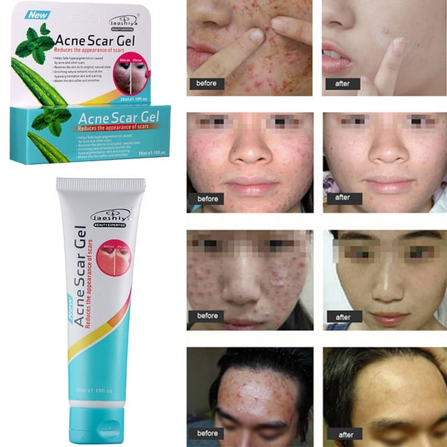 Crema para Eliminar Espinillas Hot6sl Ofertas y Liquidaciones Cuidado de La Piel 35 G