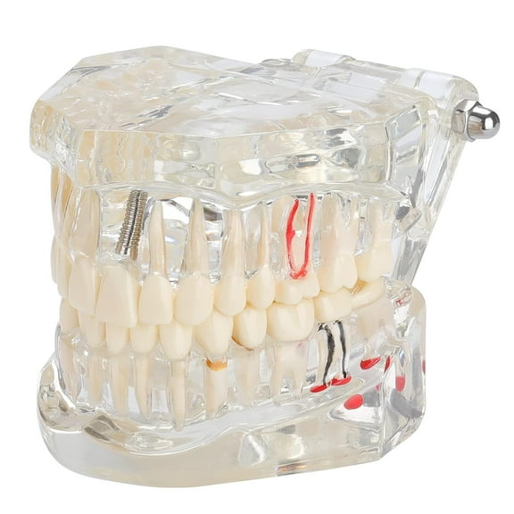 Dental Education Model Clear Implant Disease Removable Teeth Pathological Study