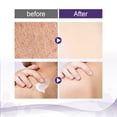 thumbnail image 3 of Keratosis Pilaris Cream for Strawberry Legs Removal Bumpy Skin Care Kp Bump Remover Body Scrubrough Body Scrub, 3 of 11