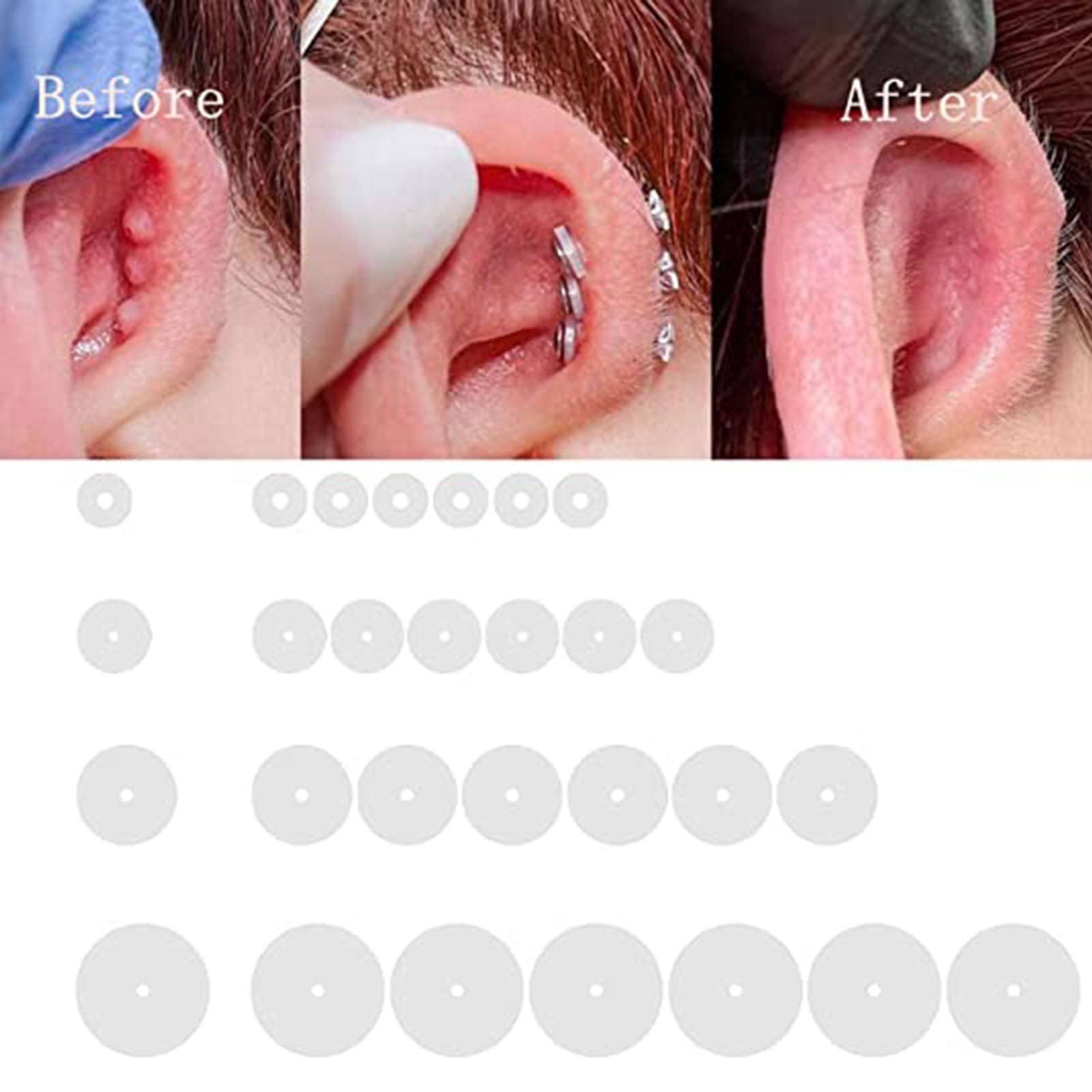 a, b Preoperative findings of a handle-shaped keloid of the right... |  Download Scientific Diagram