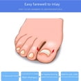 thumbnail image 5 of Parche para uñas, ranura para uñas, dispositivo de corrección de uñas, hebilla para uñas, parche para uñas, parche corrector de uñas, corrección de uñas, 5 of 5