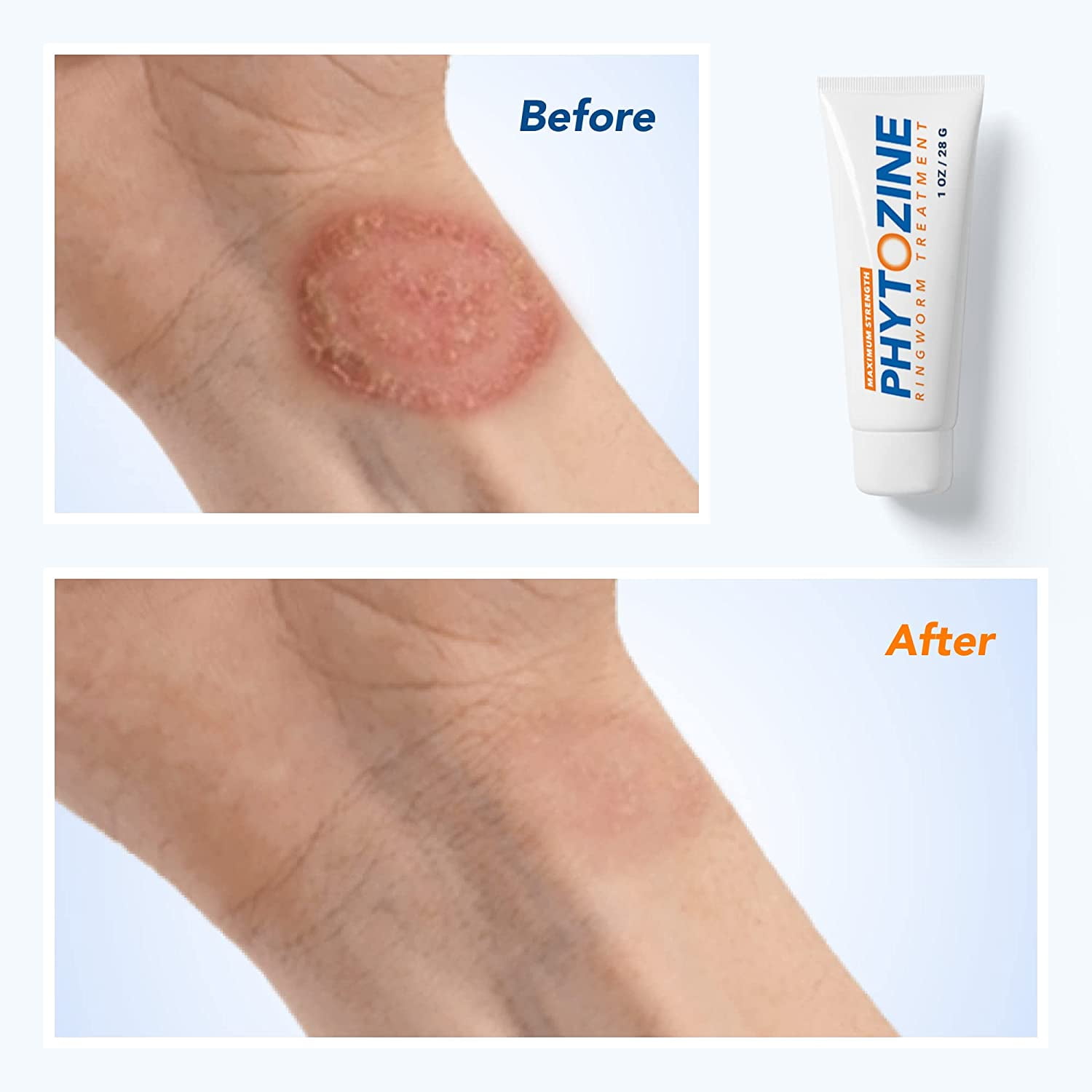 PHYTOZINE Ringworm Cream - Treats Stubborn Ringworm Infections, Fights  Ringworm On Skin, Anti-Fungal Tolnaftate, Powerful Topical Treatment (2  Tubes) - Walmart.com