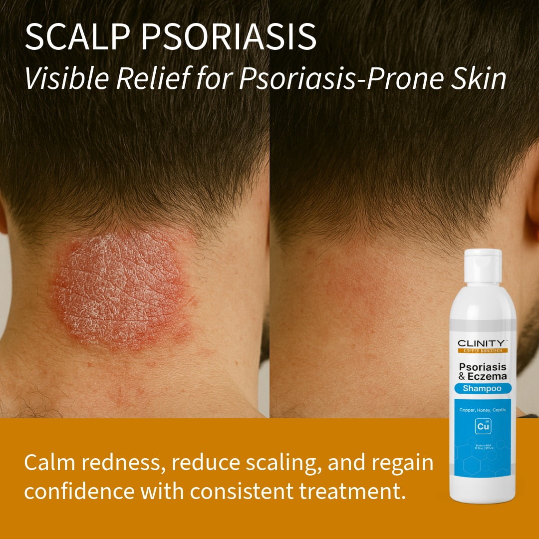 CLINITY Psoriasis & Eczema Shampoo, Hair & Scalp Treatment with Copper, Honey, and Coptis, 8 fl oz