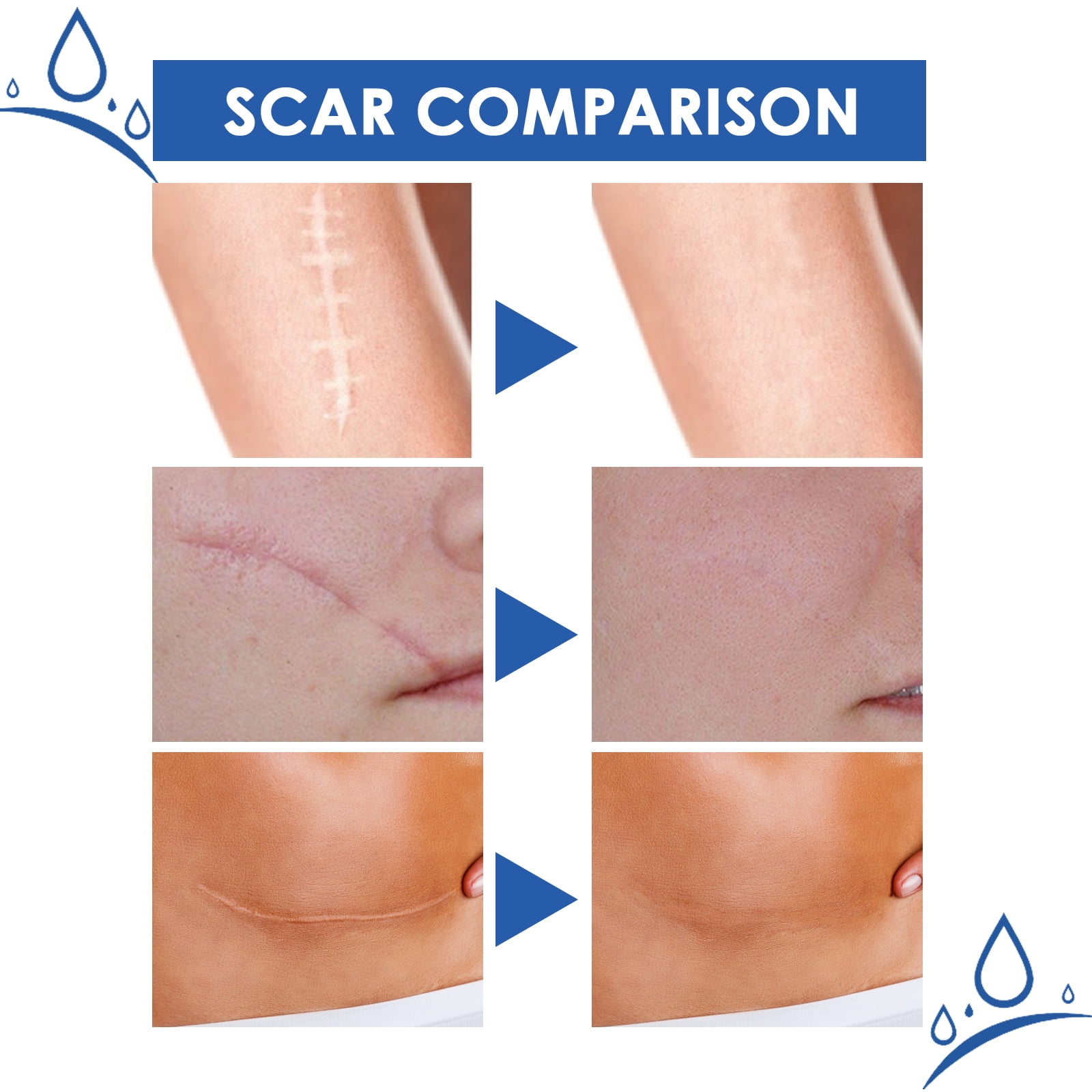 Alvantor Scar Removal Cream, Advanced Scar Gel for Face & Body, Moisturizing and Smooth 1.05oz
